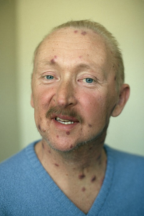 感染艾滋病病毒急性期有哪些症状？